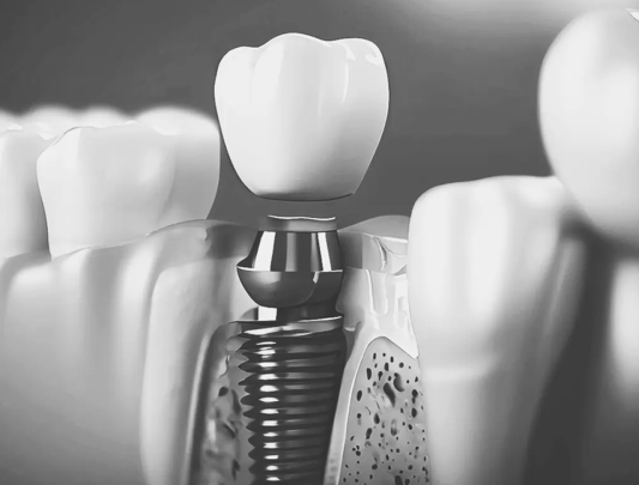 DENTALNI IMPLANTATI
