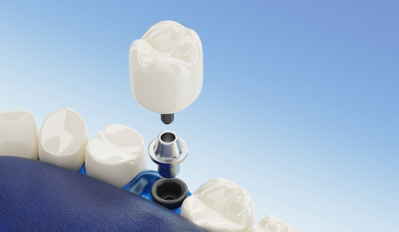 DENTALNI IMPLANTATI 