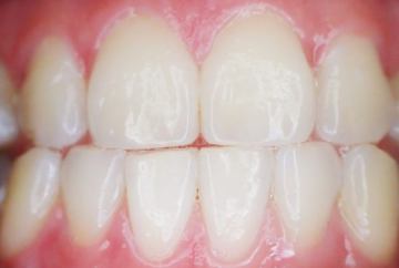 Tretman izbjeljivanja zubi 