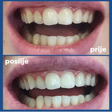 Ortodoncija, Izbjeljivanje zubi, Protetika