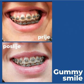 Gummy smile