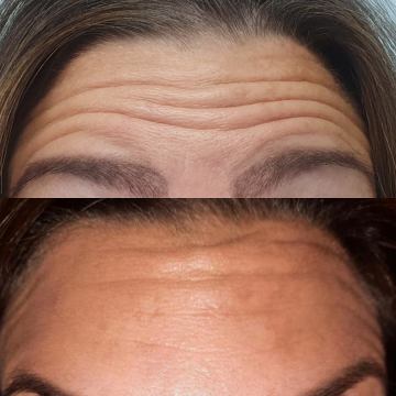 Botox tretmani