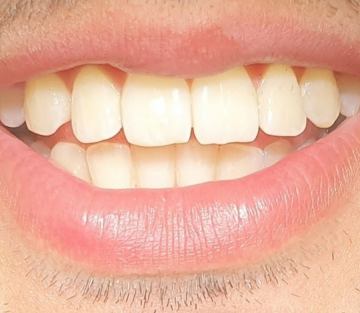 Izbjeljivanje zubi, Veneers