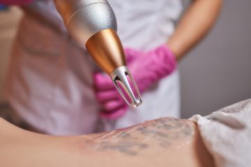 Uklanjanje tetovaže