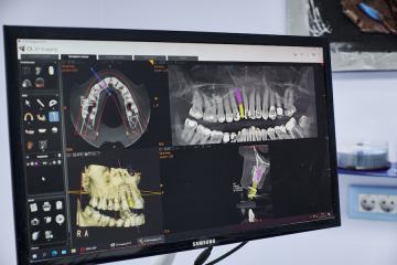 Implantologija, CAM/CAD digitalna tehnologija
