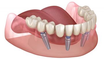 Nadomjestak zubi implantatima 