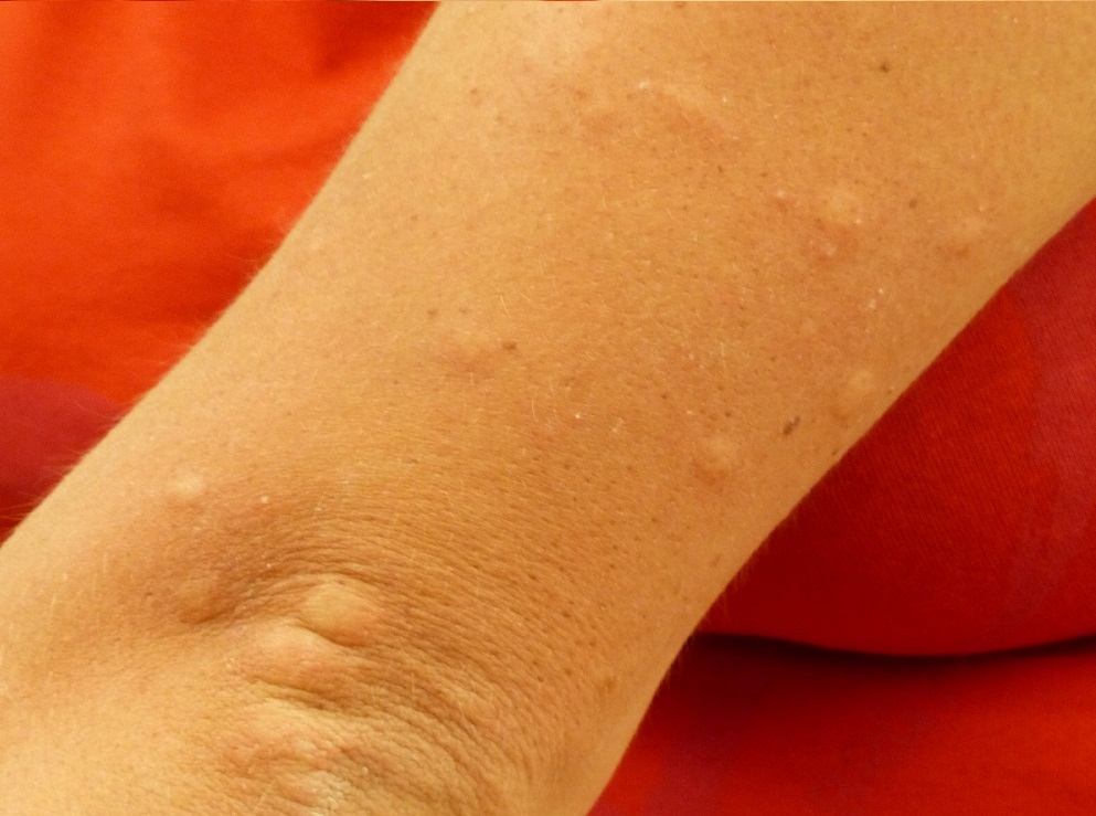 Alergija na sunce kod djece: uzroci, simptomi i postupci